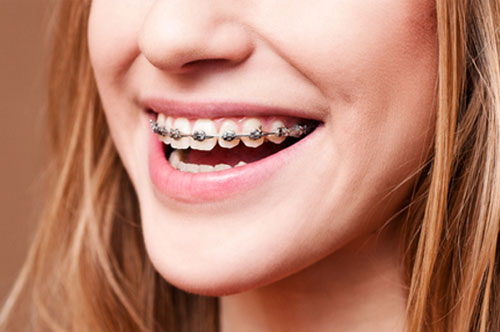 Make a Change Faster With Six Month Smiles