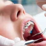 Orthodontics 3 | Houston Uptown Dentists
