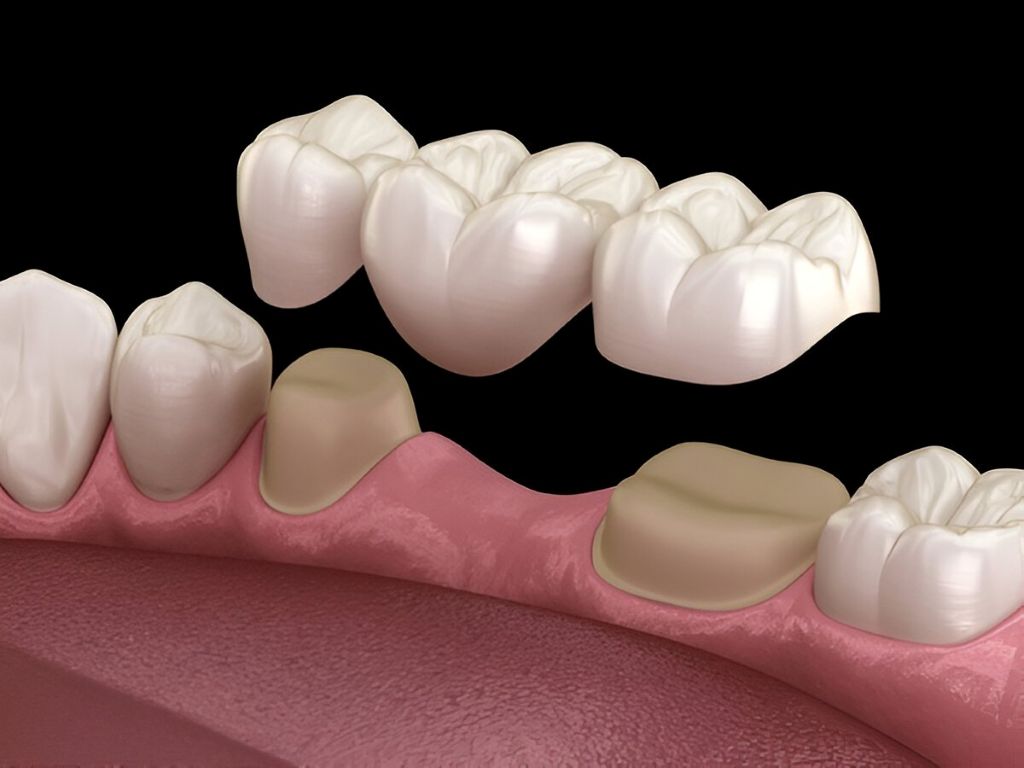 dental crowns and bridges near you