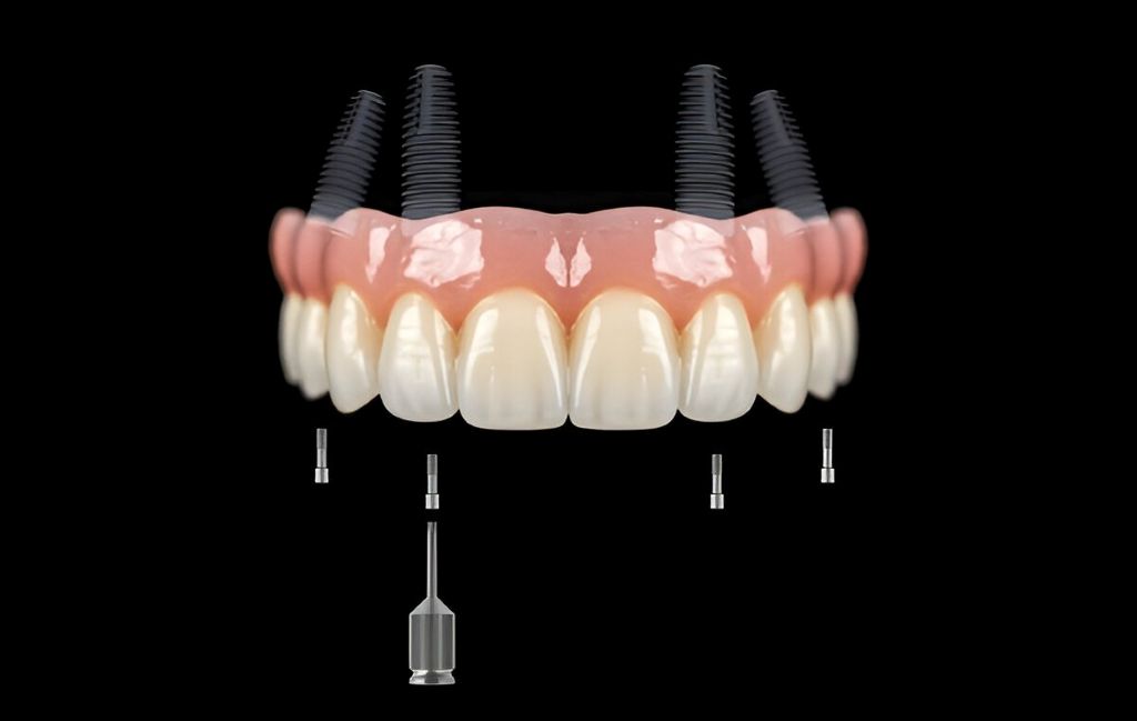full-mouth reconstruction nea you