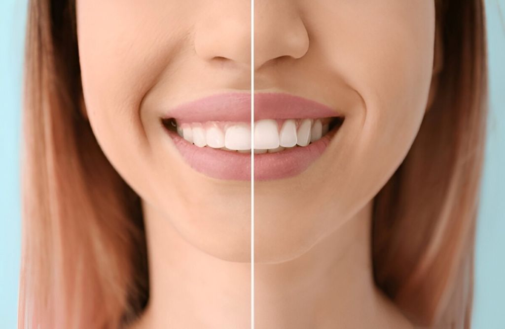 gum reshaping and gummy smile treatment near yiu
