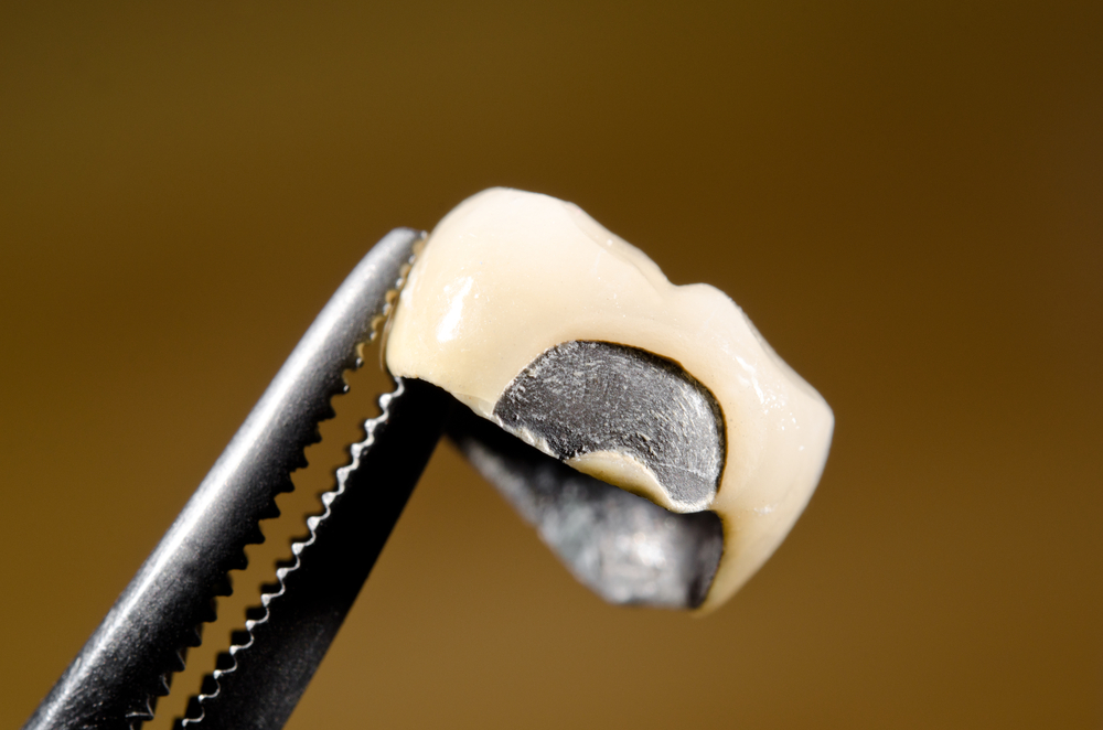 What to Do If Your Dental Crown Gets Damaged
