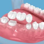 benefits of dental bridges restore your smile and function