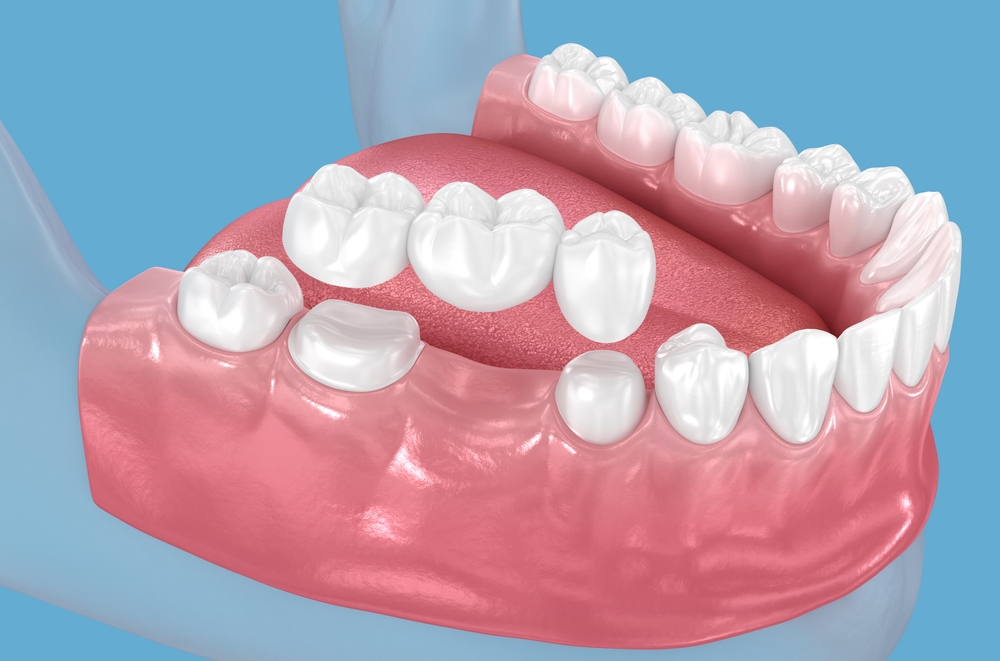 benefits of dental bridges restore your smile and function